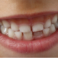歯の表面上の黄ばみはホワイトニングで元の色へ近づける
